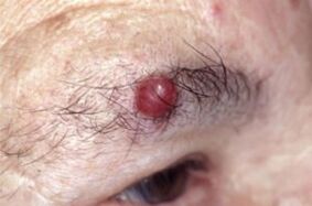 Papilloma bekainetan