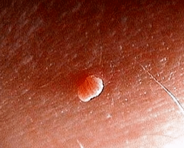 Gorputzean papiloma