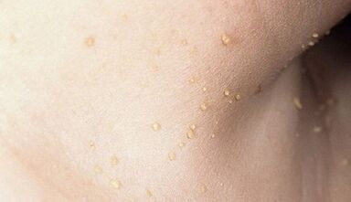 lepoan papilomatosia garatzeko arriskua