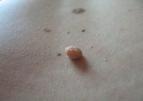 Papiloma azalaren gainazaleko hazkuntza da