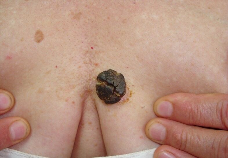 keratoma giza gorputzean