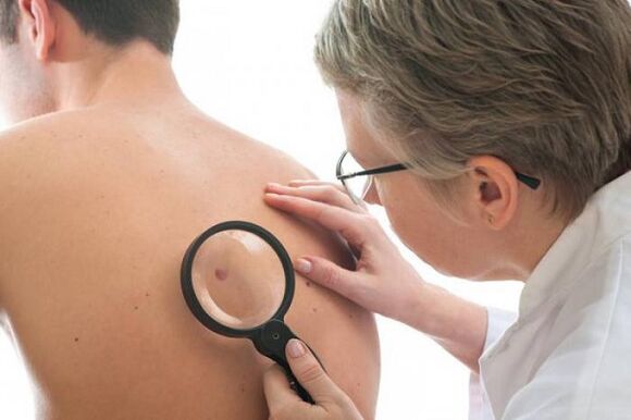 medikuak papiloma aztertzen du bizkarrean