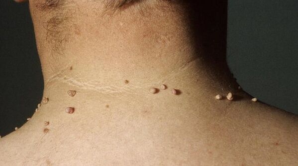 papiloma filiformea ​​lepoan