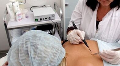 Elektrokoragulazioa beruna kentzeko metodo gisa